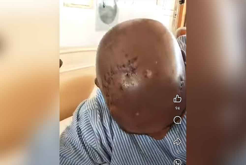 Tangkap layar video Surej menunjukkan kesan jahitan pada kepala nya akibat diterkam harimau kumbang