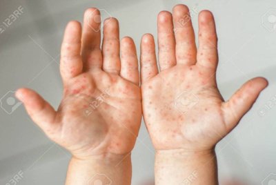 Kes HFMD di Kelantan meningkat 10 kali ganda kepada 4,591 kes dari Januari hingga 5 April lepas. Foto hiasan