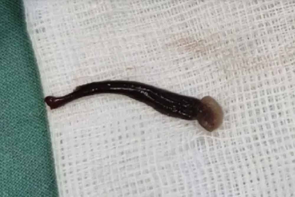 Lintah yang dipercayai 'hidup' dalam hidung kanak-kanak tersebut. Foto sumber Thairath