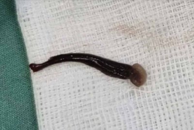 Lintah yang dipercayai 'hidup' dalam hidung kanak-kanak tersebut. Foto sumber Thairath