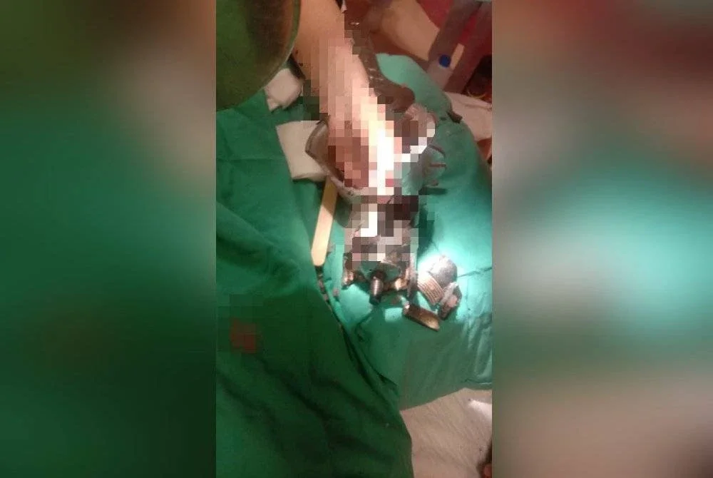 Tangan mangsa tersekat pada mesin pengisar daging dan terpaksa dihantar ke hospital untuk rawatan segera.