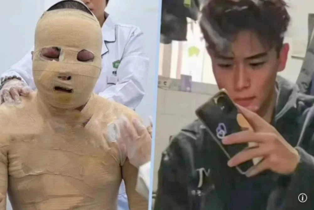 Kejadian bateri basikal elektrik meletup menyebabkan badan Junhao melecur 90 peratus. Agensi