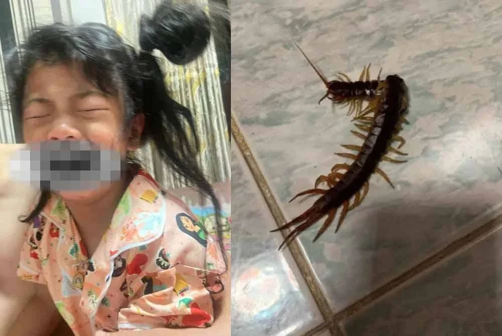 Mangsa mengalami kecederaan di mulut akibat digigit lipan semasa tidur. - Agensi