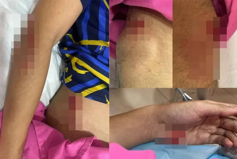 Darius Hazreeq cedera pada kaki, tangan dan badan dalam kejadian dikejar tiga ekor anjing liar di kawasan Rasah Jaya Sabtu lalu. - Foto: Darius Hazreeq