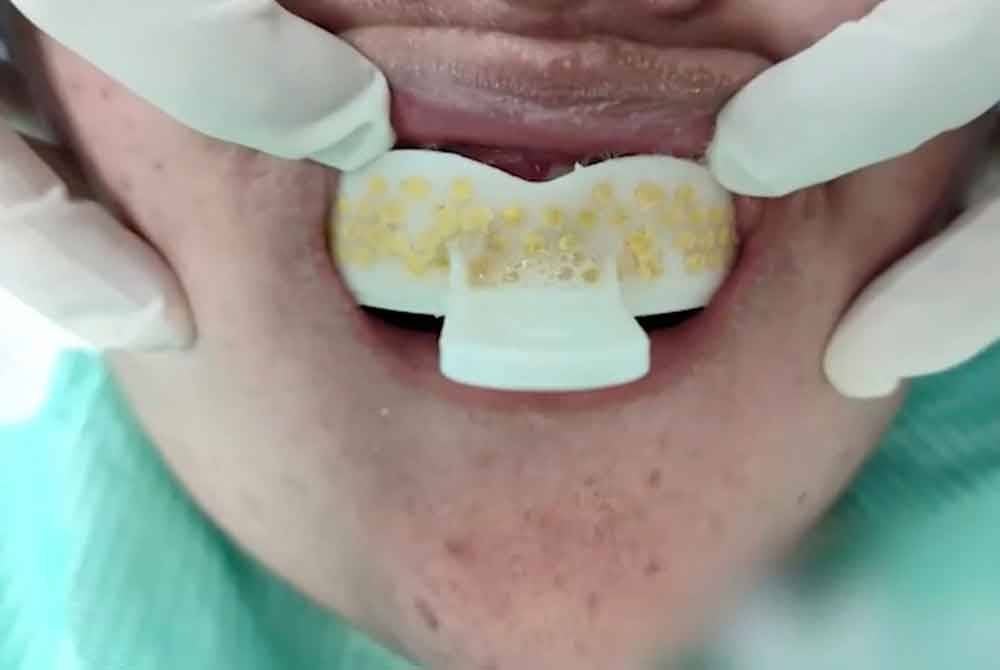 Wanita nyaris maut buat acuan gigi sendiri guna kit murah