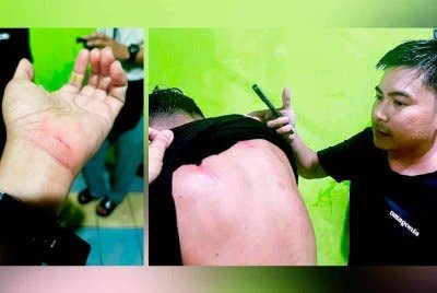 Mangsa mengalami calar di bahagian belakang badan selepas dihempap papan tanda di tapak 