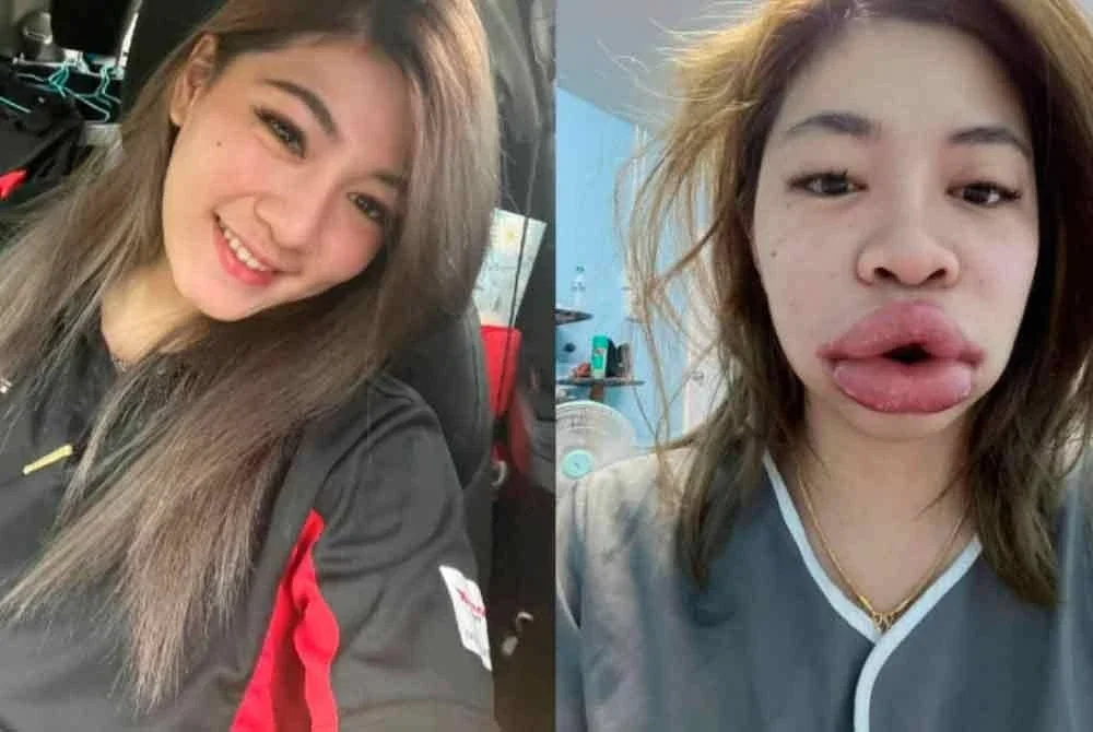 Keadaan bibir wanita itu yang dikongsinya di Facebook.-Agensi