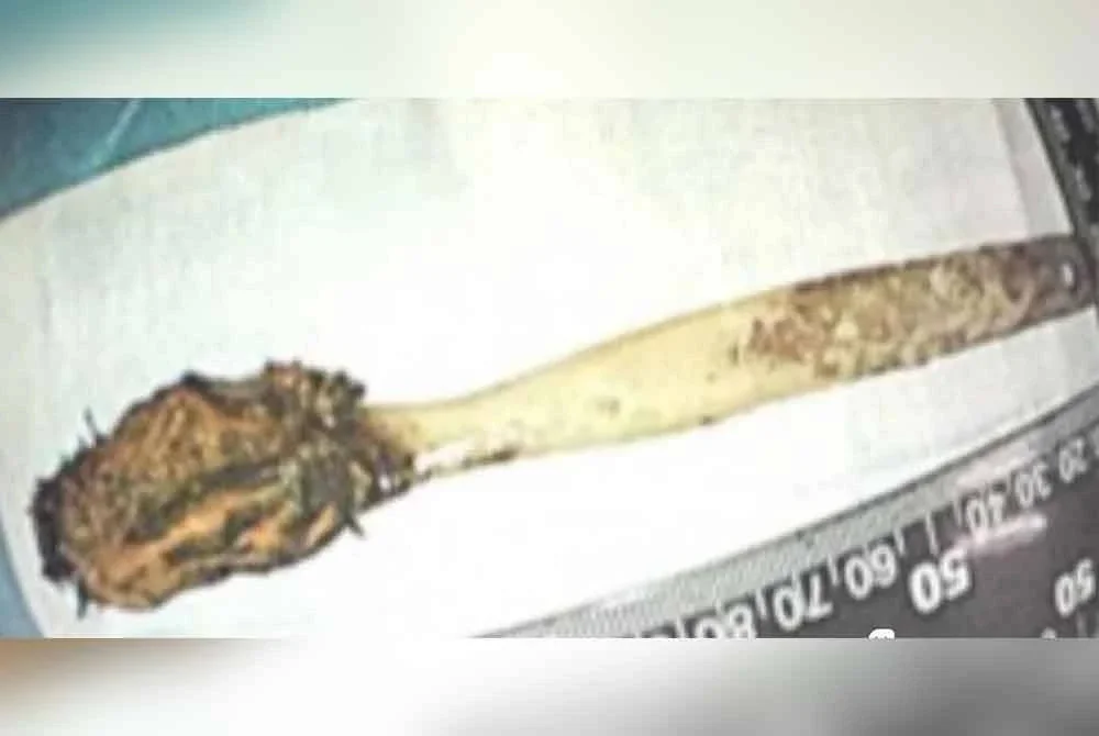 Keadaan berus gigi tersebut yang dikeluarkan menerusi prosedur endoskopik. Foto Agensi