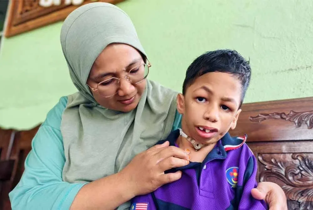 Adib Rasul menghidap penyakit sindrom Nager atau ketiadaan rahang sejak lahir.