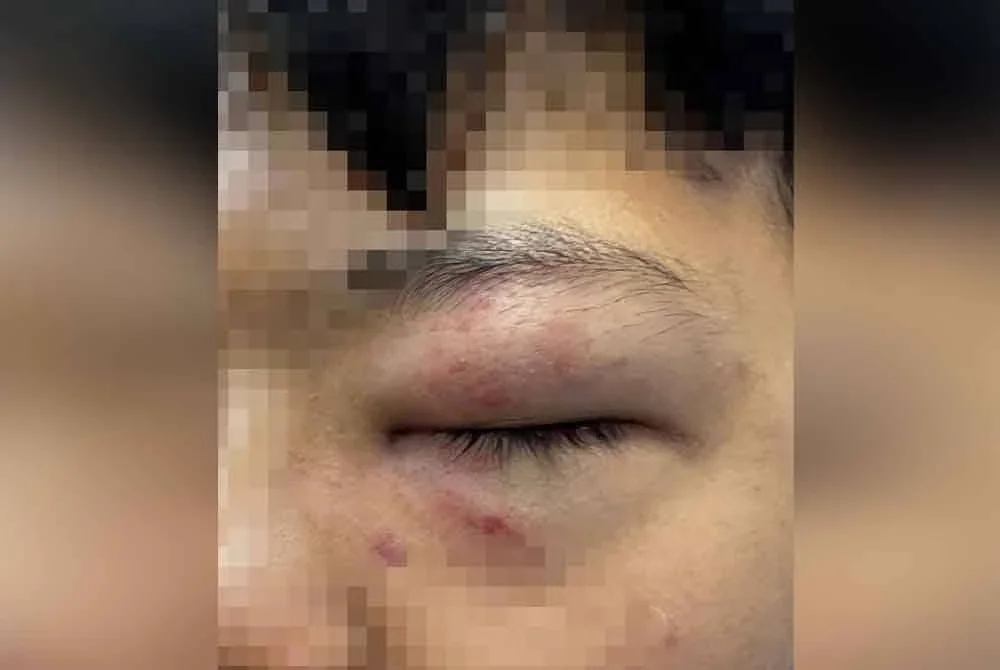 Keadaan mangsa yang lebam di mata disyaki ditumbuk rakan dalam kejadian pada Isnin.