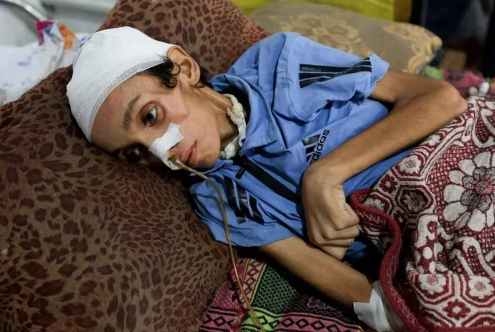 Mosab al-Debs,14, mengalami malnutrisi dirawat di Hospital al-Shifa di Bandar Gaza.
