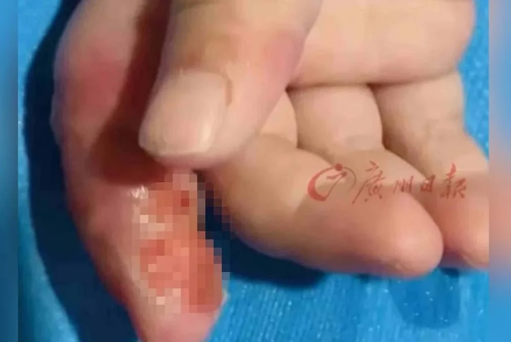 Lele dibawa ke Hospital Kanak-Kanak Hunan selepas jarinya membengkak dan mengelupas. Agensi