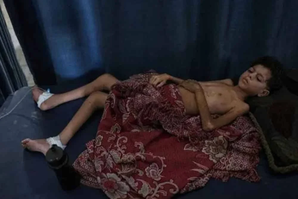 Saif Hijazi, 13, yang menghidap kekurangan zat makanan serius dan sebahagiannya lumpuh akibat serangan peluru terbaring di atas katil ketika gambarnya dirakam di Hospital al-Shifa, Gaza, baru-baru ini. Foto AP