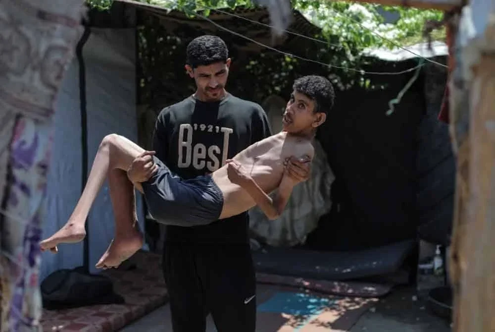 Hamza Mishmish, 25, yang tinggal di kem pelarian Nuseirat, kehilangan jisim tulang yang ketara akibat malnutrisi yang teruk.