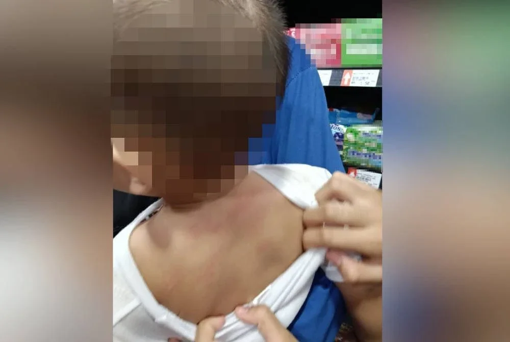 Kecederaan yang dialami oleh bayi lelaki berusia 11 bulan yang hampir menjadi tebusan perompak warga Vietnam dalam kejadian pada Sabtu.