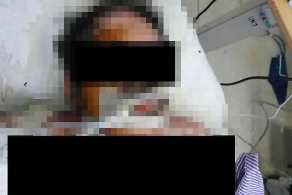 Wanita yang dibakar kekasihnya kini dirawat di HEBHK, Kluang dan terpaksa ditidurkan kerana melecur teruk. - Foto IPD Kluang