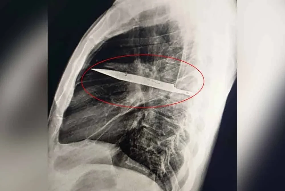 Imej sinar X menunjukkan kedudukan bilah pisau tersebut yang tidak mengenai mana-mana organ penting. - Foto Agensi