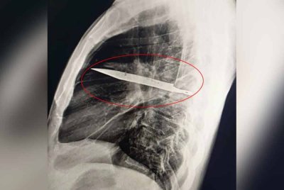 Imej sinar X menunjukkan kedudukan bilah pisau tersebut yang tidak mengenai mana-mana organ penting. - Foto Agensi