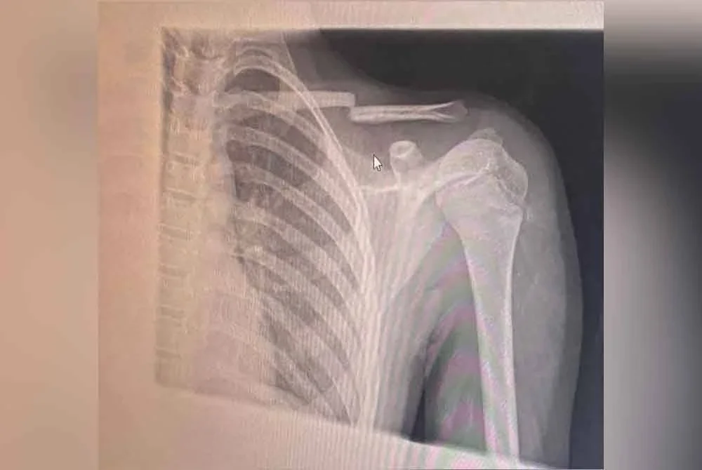 Gambar pemeriksaan x-ray kecederaan mangsa dikongsi ibunya kepada Sinar Harian.