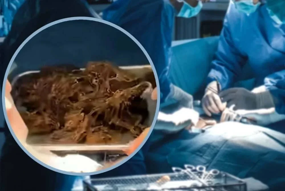 Doktor menemui bebola rambut bercampur sisa makanan yang memenuhi hampir keseluruhan perutnya yang dikenal pasti sebagai punca kepada siri penyakit yang dialami.