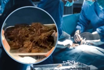 Doktor menemui bebola rambut bercampur sisa makanan yang memenuhi hampir keseluruhan perutnya yang dikenal pasti sebagai punca kepada siri penyakit yang dialami.