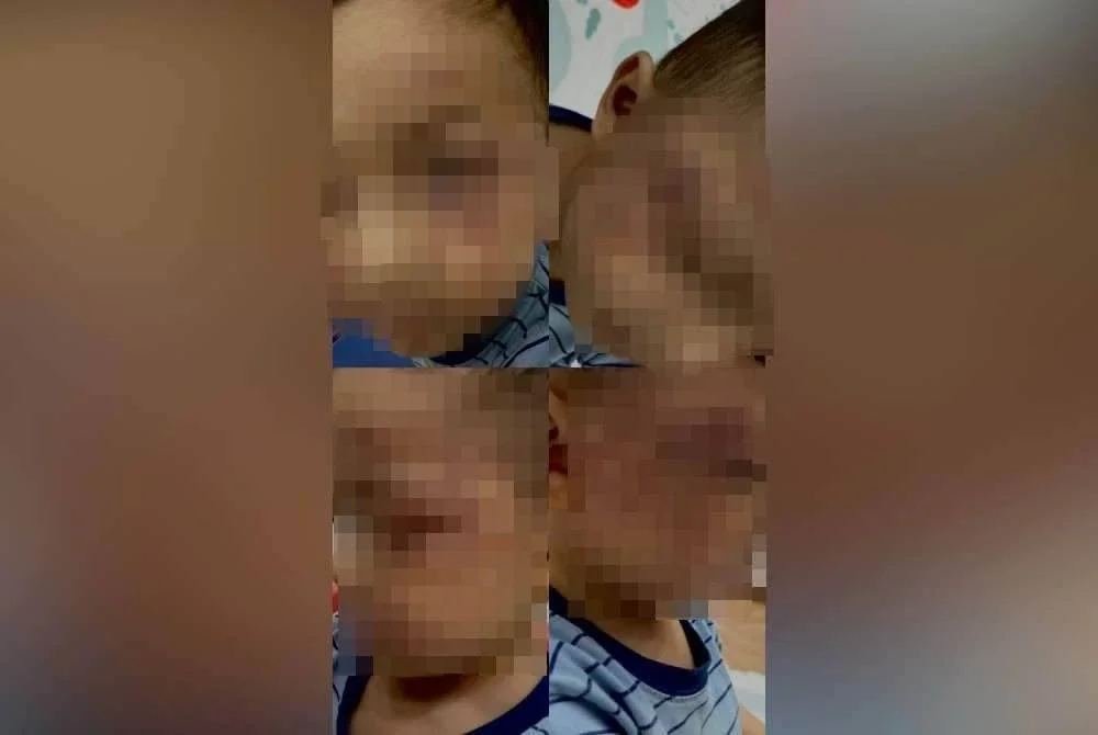 Kanak-kanak berusia dua tahun dipercayai didera, wajahnya kelihatan lebam selepas dihantar pulang pengasuh.