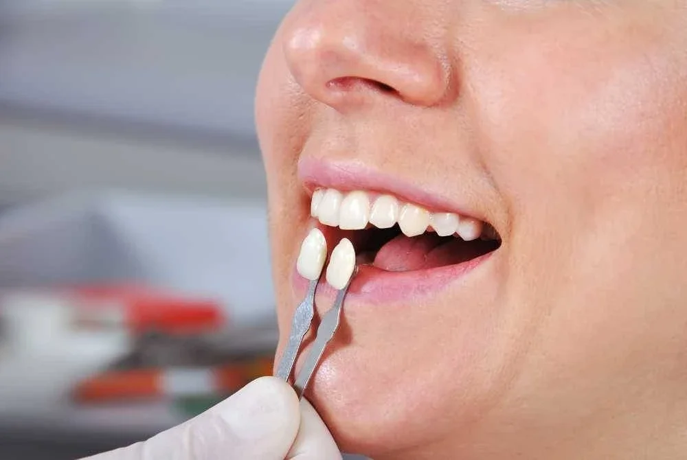 JIKA gigi asal seseorang sudah elok, putih dan tersusun, tetapi tetap memilih ‘veneer’ semata-mata untuk menambah kilauan, ia tidak digalakkan. -Gambar hiasan/ Foto: CANVA