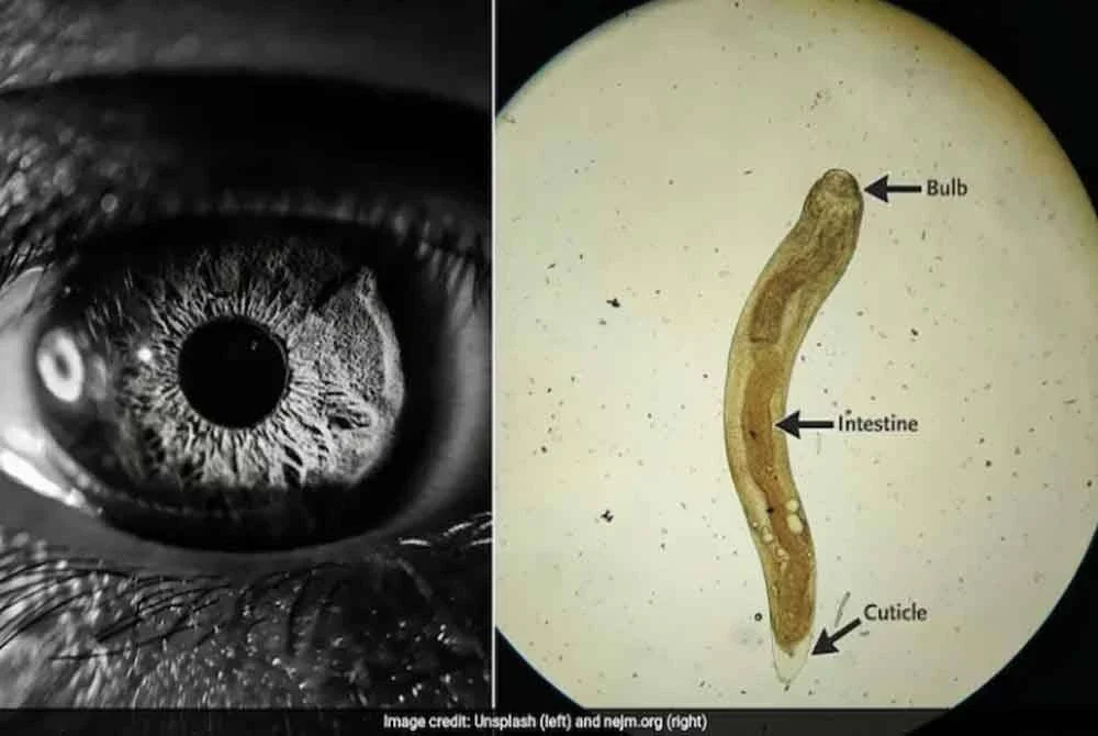Ulat parasit yang ditemui dalam mata pesakit di New Delhi, India. Foto Agensi