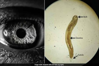 Ulat parasit yang ditemui dalam mata pesakit di New Delhi, India. Foto Agensi