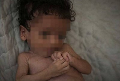 Salem Awad, antara bayi yang menderita akibat kekurangan zat makanan hanya mampu terbaring di atas tilam dalam khemah keluarganya di Gaza City. Foto AP