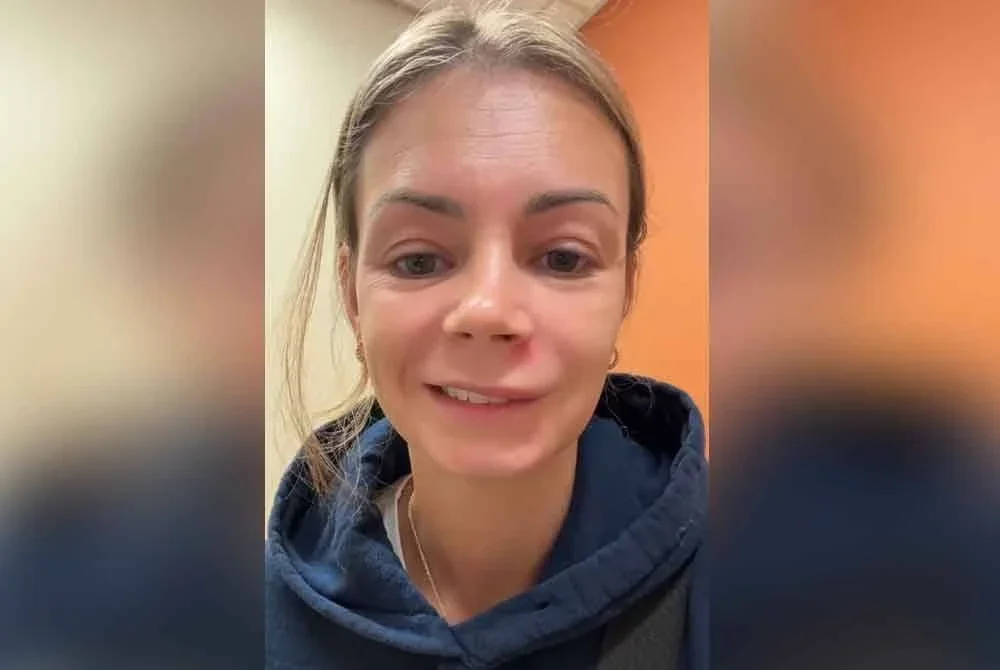 Lish menunjukkan dia mengalami strok wajah sementara selepas memicit jerawat bawah hidung. - Agensi