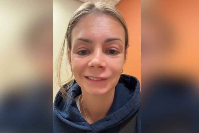 Lish menunjukkan dia mengalami strok wajah sementara selepas memicit jerawat bawah hidung. - Agensi