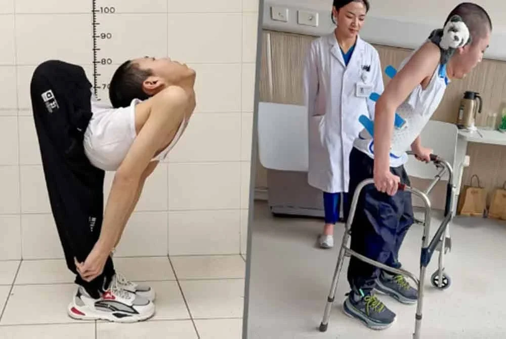 Perbezaan keadaan Jiang sebelum (kiri) dan selepas menjalani pembedahan membetulkan tulang. - Agensi