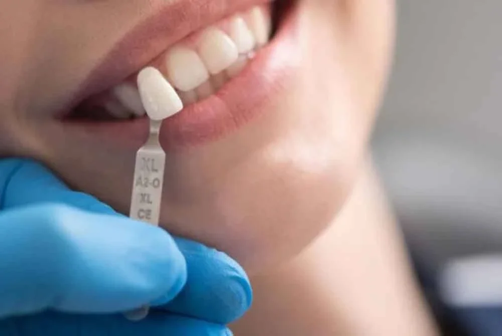 Seorang wanita di Florida ditahan selepas didakwa menawarkan rawatan veneer tanpa lesen menggunakan gam industri - Gambar hiasan