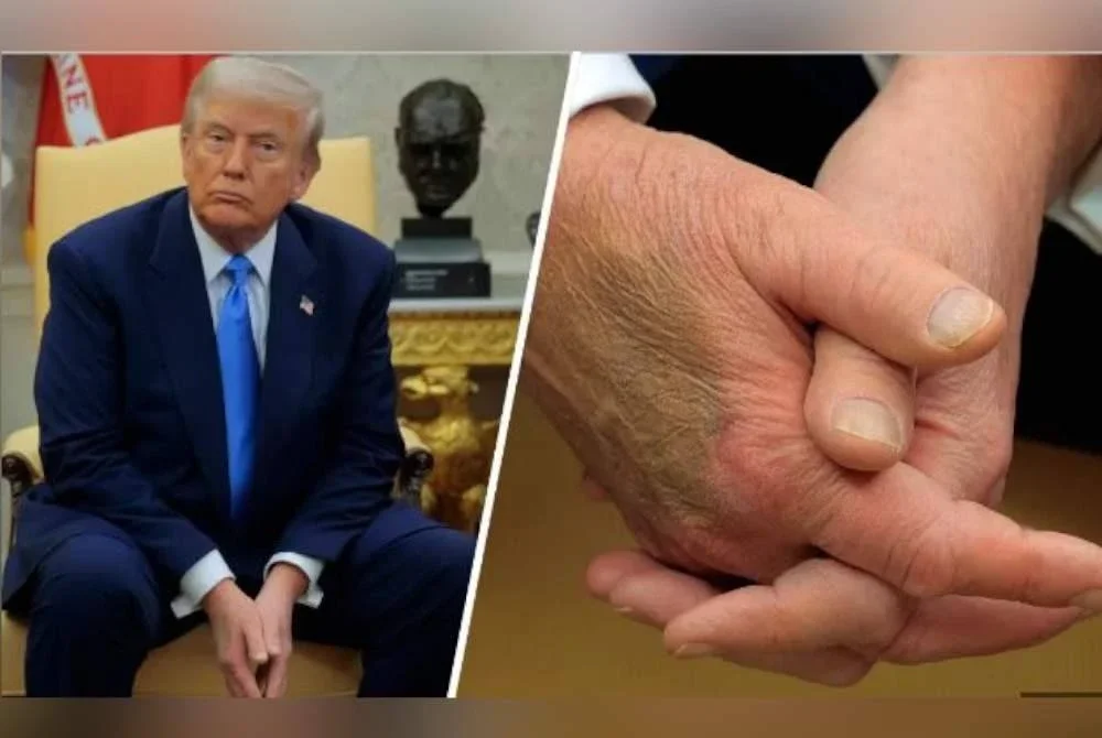 Trump didiagnos menghidap penyakit urat tidak berbahaya setelah timbul spekulasi tentang tangannya yang lebam teruk pada Julai lalu. Foto Agensi