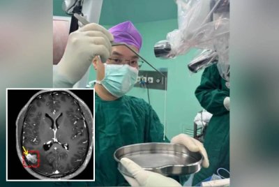 Doktor mengeluarkan cacing sepanjang 18 sentimeter dari otak seorang lelaki. Foto Agensi