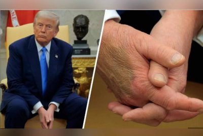 Trump didiagnos menghidap penyakit urat tidak berbahaya setelah timbul spekulasi tentang tangannya yang lebam teruk pada Julai lalu. Foto Agensi