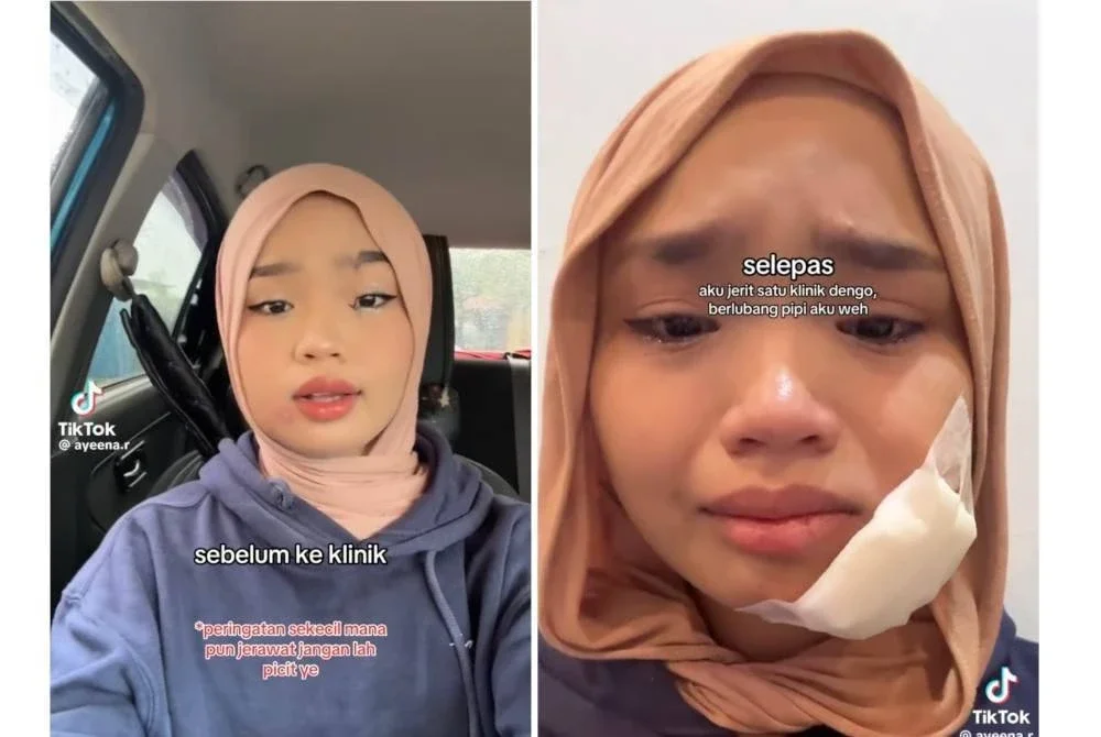 Pipi Aina Batrisyia membengkak selepas dia memicit jerawat. (Kanan: Nanah telah dikeluarkan dan bahagian luka telah dicuci doktor.)