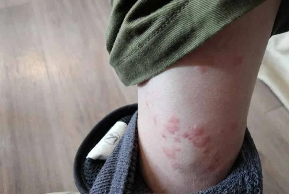 Ruam merah kelihatan pada kaki seorang askar. Foto: Agensi