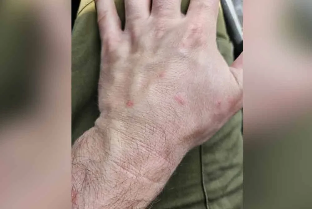 Keadaan tangan seorang askar akibat diserang pepijat.Foto: Agensi