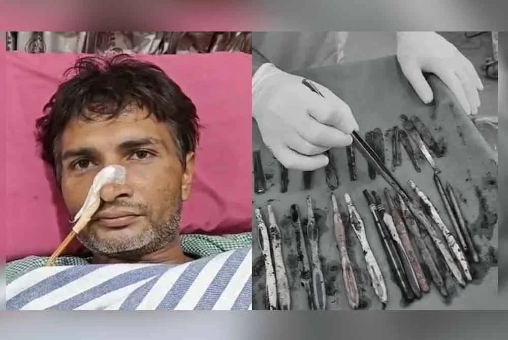 Sekumpulan pakar bedah berjaya mengeluarkan 29 sudu besi, 19 berus gigi, dan dua pen dari perut seorang lelaki. Foto Agensi