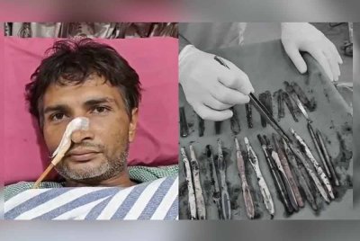 Sekumpulan pakar bedah berjaya mengeluarkan 29 sudu besi, 19 berus gigi, dan dua pen dari perut seorang lelaki. Foto Agensi