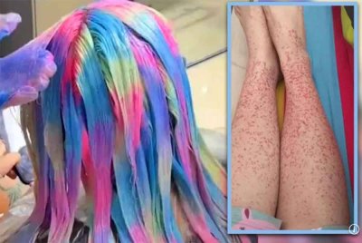 Seorang wanita di China menghidap penyakit buah pinggang selepas terlalu kerap mewarnakan rambut bagi meniru gaya selebriti kegemarannya.