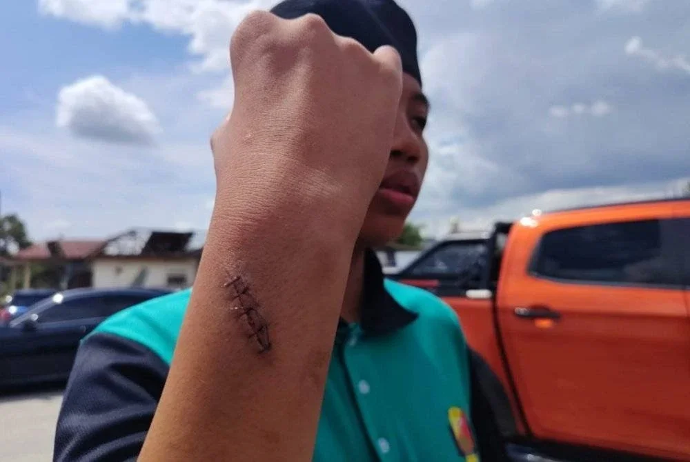 Muhammad Daris Isyraf Roshamri menunjukkan kecerderaaan dialami