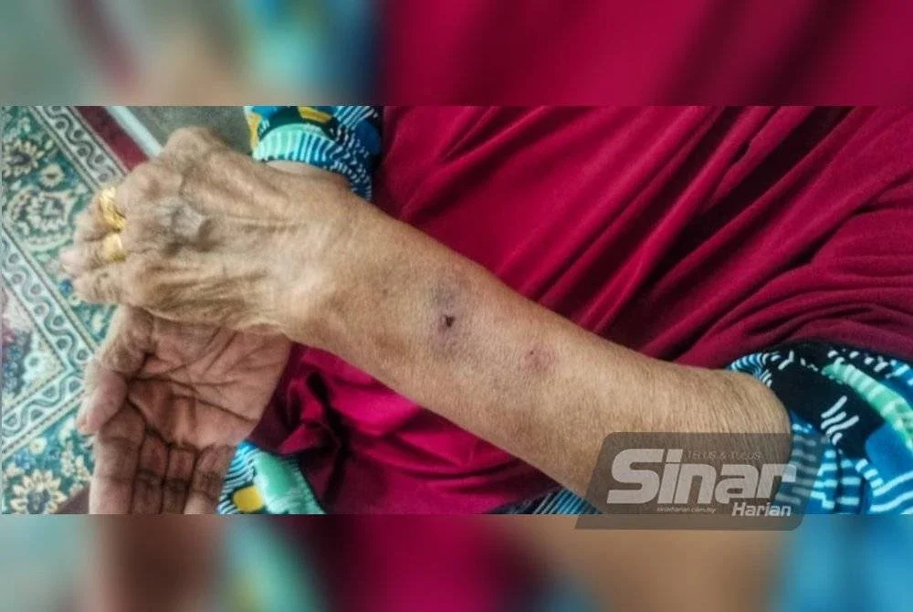 Kesan lebam yang dialami warga emas tersebut.