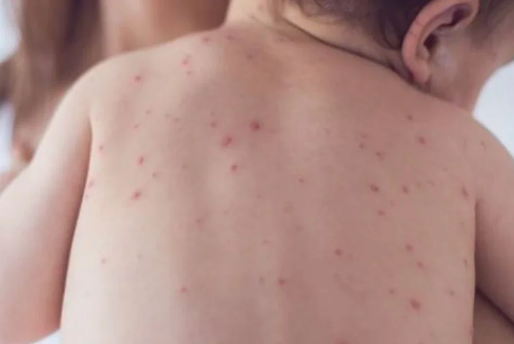 Israel kini berdepan dengan wabak campak yang semakin membimbangkan. Gambar hiasan