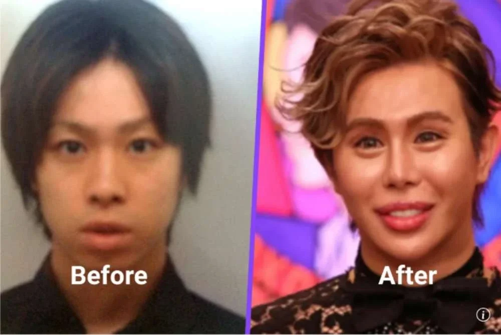 Wajah Allen sebelum (kiri) dan selepas melakukan pembedahan plastik untuk mencantikan wajahnya di wilayah Kochi. - Agensi