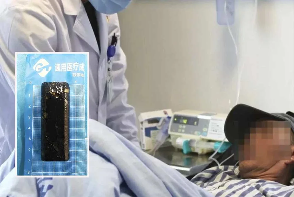 Pemetik api dalam perut dikeluarkan guna kondom Pemetik api dalam perut dikeluarkan guna kondom