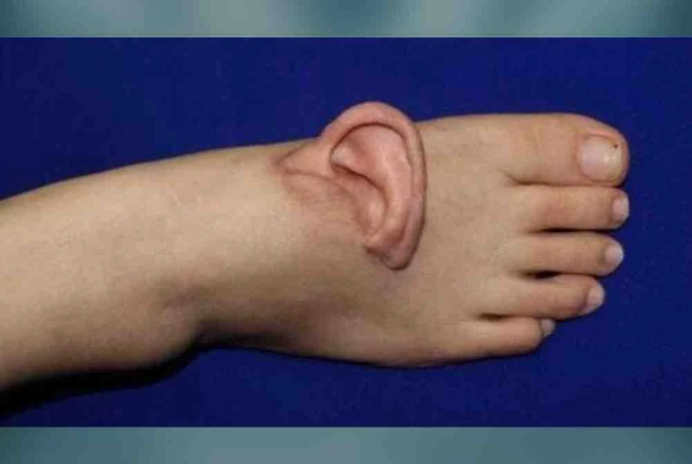 Telinga yang terputus dirawat pada kakinya selama lima bulan sebelum pembedahan akhir.