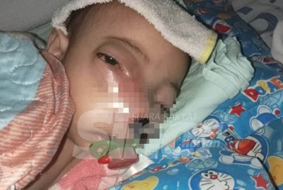 Keadaan Firas Affan yang menghidap ketumbuhan 'Germ Cell' di belakang mata sebelum menjalani rawatan
